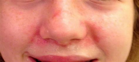 redness around nose cheeks mouth causes pictures get