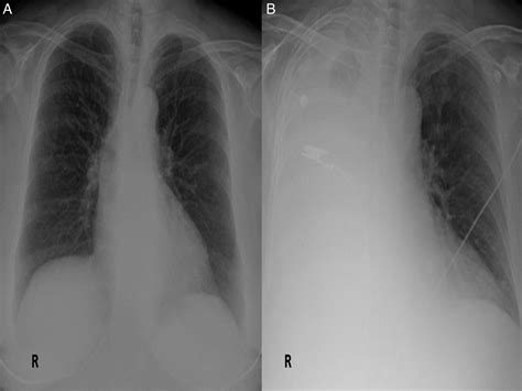 Unilateral Pleural Effusion In A Peritoneal Dialysis Patient Bmj Case