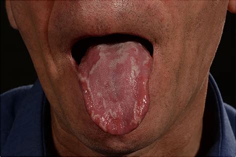 geographical tongue induced by axitinib bmj case reports