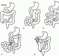 Bildergebnis für Malrotation mit Dünndarm-volvulus. Größe: 192 x 185. Quelle: journals.sagepub.com