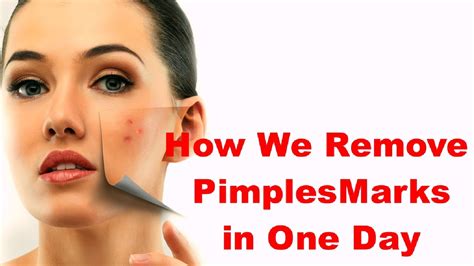 howto how to get rid of acne marks on face