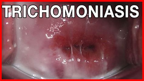 signs and symptoms of trichomoniasis in men pictures youtube