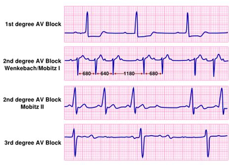 Bradycardia Textbook Of Cardiology