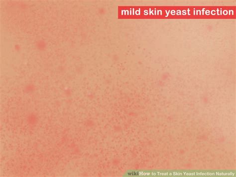 how to treat a skin yeast infection naturally