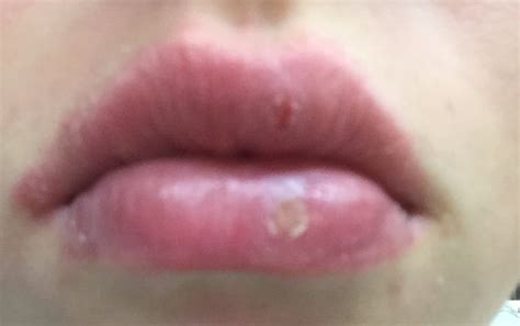 problème aux lèvres bouche