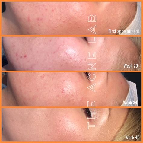 blackheads  acne lab