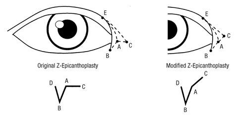 modified z epicanthoplasty in the asian eyelid facial plastic