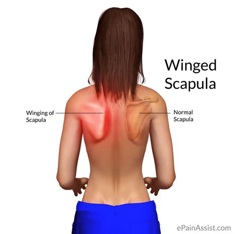 winged scapula  scapular winging treatment exercise