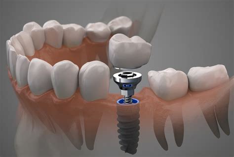 dental implant procedure santa rosa ca