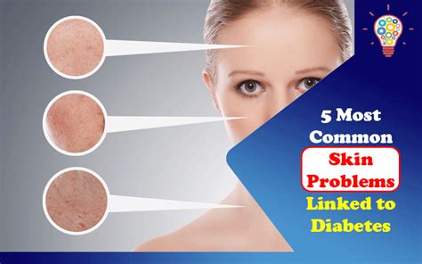common skin problems linked  diabetes updated ideas