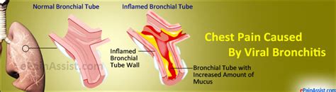 viral bronchitis treatment causes symptoms investigations