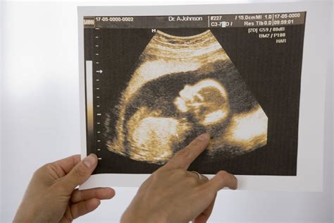 transvaginal ultrasound  pregnancy