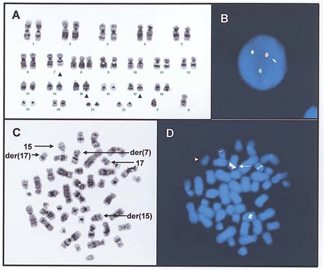 Conventional And Molecular Cytogenetic Analysis Of Case 52 A
