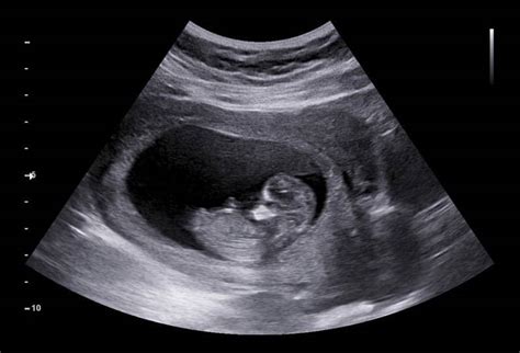 private ultrasound scan