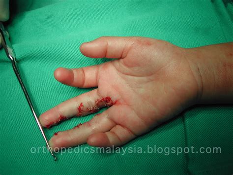Syndactyly Joined Together The Orthopedics Malaysia Blog