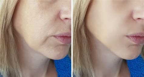 Cosmetic Fillers Advanced Dermatology Of The Midlands