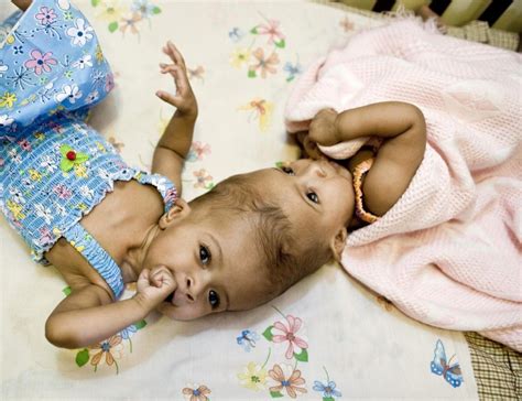 Miracle Surgery Saves Conjoined Twins Attached At Head Ibtimes