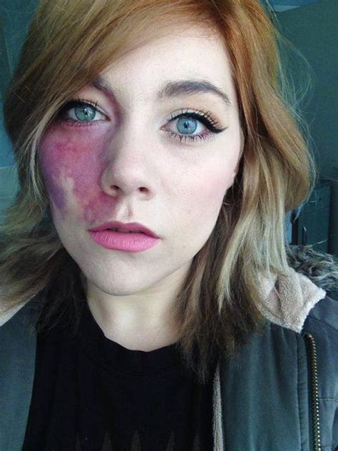 A Tv Producer Thought This Womans Birthmark Made Her ‘too Ugly To Love
