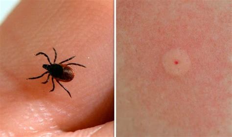 lyme disease outbreak    symptoms  lyme disease