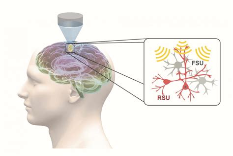 ultrasound offers focused noninvasive option  neuropsychiatric disorders