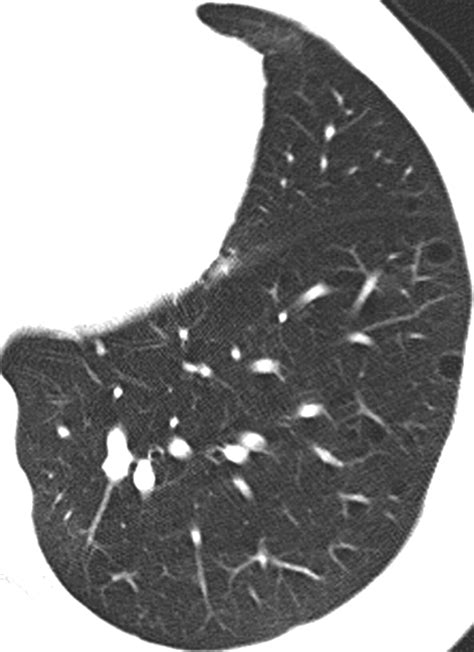 Thin Section Ct Of The Lungs The Hinterland Of Normal Radiology