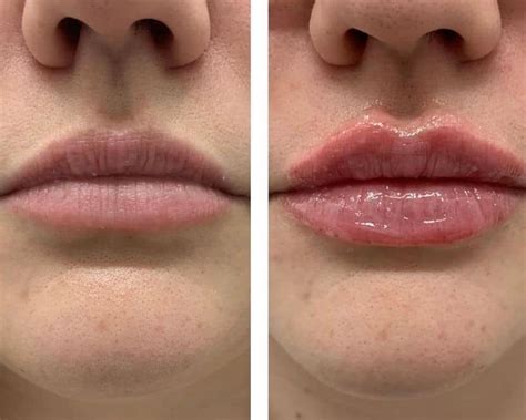 lip filler  lip flip