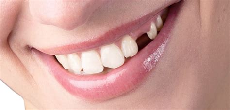 dental myth knocked  teeth  lost  oral
