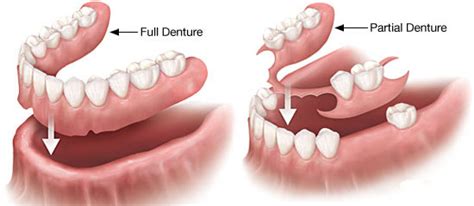 dentures laser holistic dental