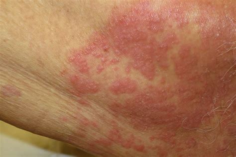 yeast infection  skin   identify  treat rash