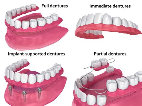 dentures greenwood ms todd fincher dds smiles  life