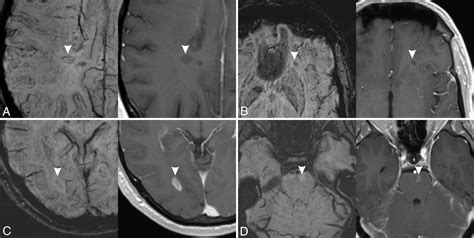 Swi As An Alternative To Contrast Enhanced Imaging To Detect Acute Ms