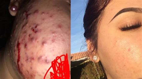 This Teen Is Claiming Green Tea Cleared Her Cystic Acne In Viral Before