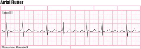 Atrial Flutter Causes Symptoms Treatment And Ablation