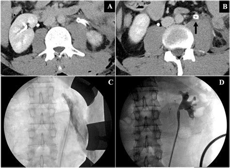 A Delayed Excretory Phase Ct Scan With Contrast Material Extravasation