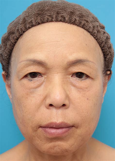 目の下、法令線、口周りシワにヒアルロン酸を6本注射した60代女性の症例写真 ： 美容整形の高須クリニック（東京赤坂・横浜・名古屋・大阪）