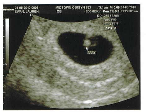 baby swanpenter  week ultrasound