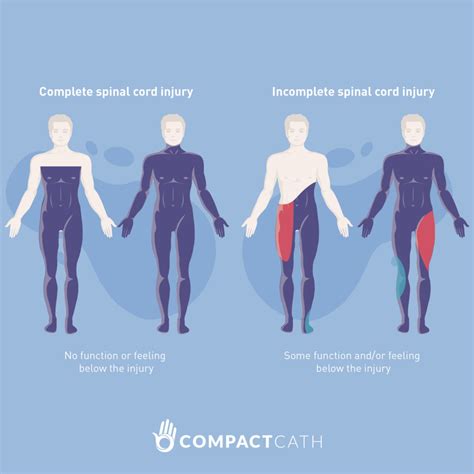 Spinal Cord Injuries And Neurogenic Bladders Compactcath
