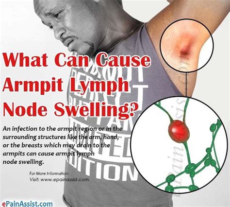 Painful Pea Sized Lump In Armpit 13 Home Remedies To