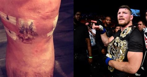 ufc news michael bisping shows off severely swollen knee after surgery