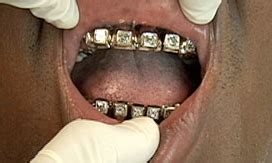 diamond teeth archives   hip