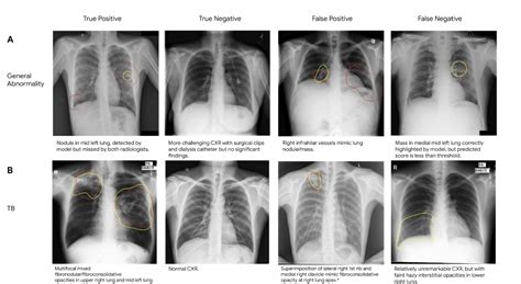 google ais  deep learning model detects abnormal chest  rays