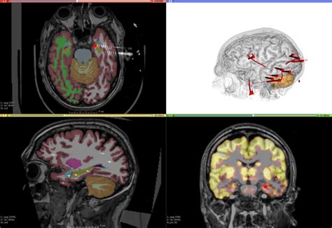 stereoelectroencephalography seeg epilepsy unit parc de salut mar
