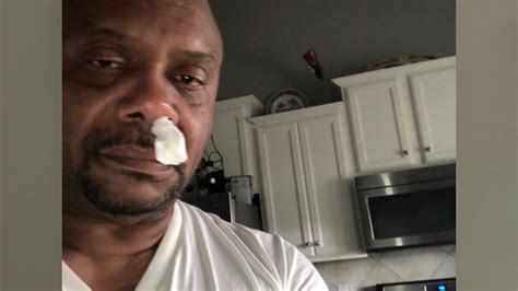 Brain Fluid Leaking Through Nose Nc Man S Runny Nose Turns Out To Be
