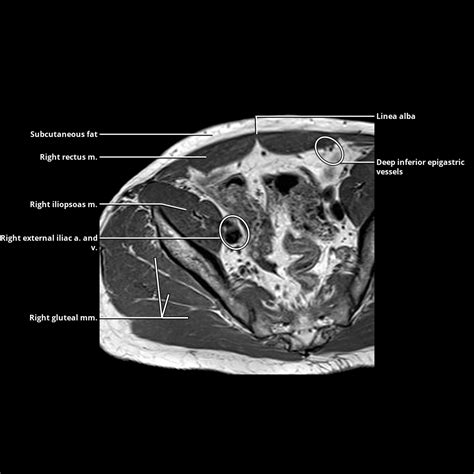 abdominal wall radiology key