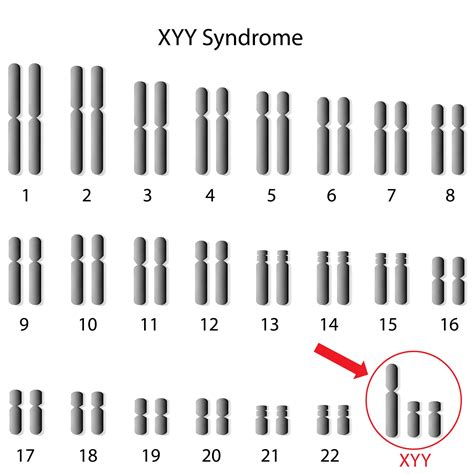Xyy Syndrome Causes Symptoms Prevention And Treatment