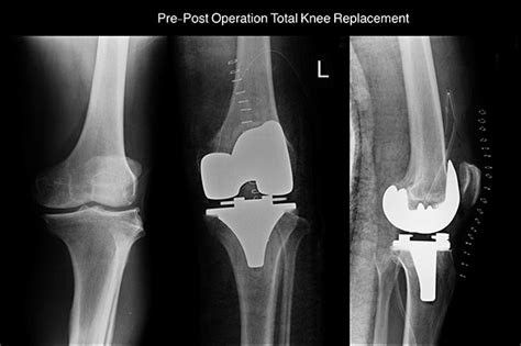 Xray Left Knee And Show Pre Post Operation Total Knee