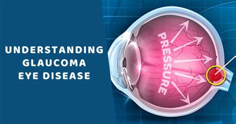 Understand Glaucoma Eye Disease Introduction Types Causes And Symptoms