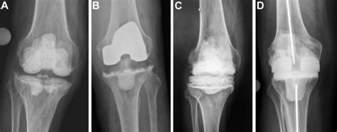 stage treatment  total knee arthroplasty infection utilizing