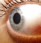 Image result for conjuntival. Size: 176 x 185. Source: activevision.com.mx