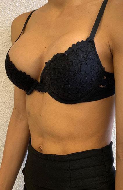 male to female breast augmentation case07 before and after